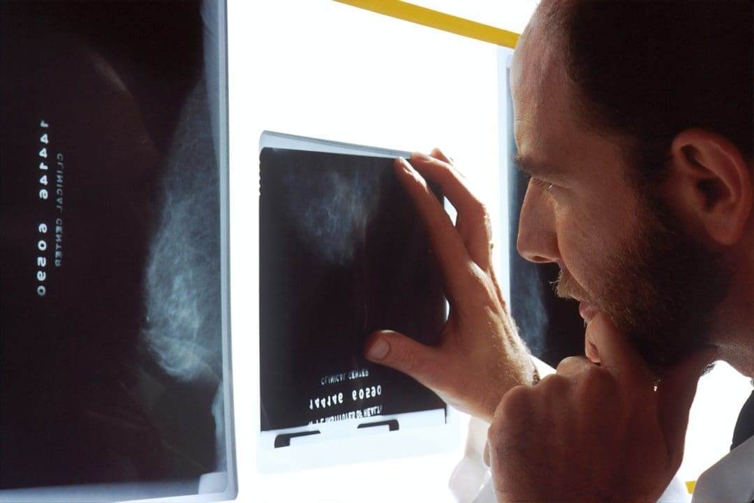 screening cancer